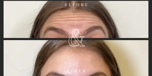 Before and After Botox Forehead