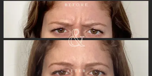 Before and After Botox Forehead