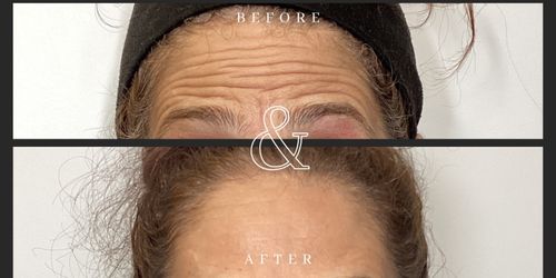 Before and After Botox Forehead