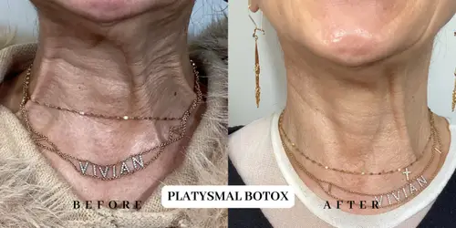 Before and After Botox Neck