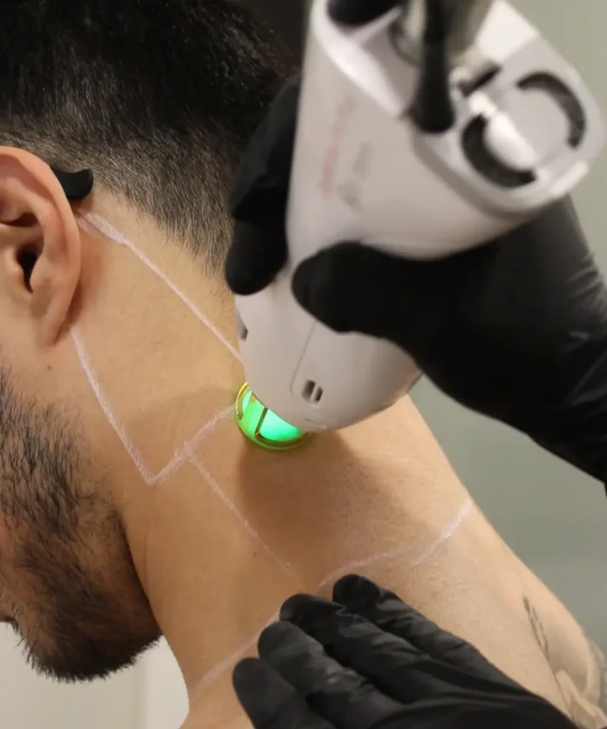 Men's Neck Laser Hair Removal