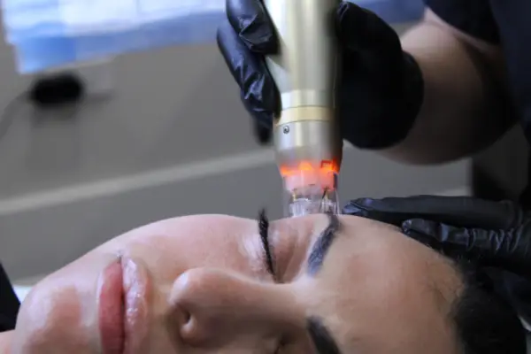 RP Microneedling on face